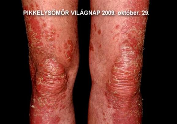pikkelysömör klinika what is the best over the counter medicine for psoriasis?
