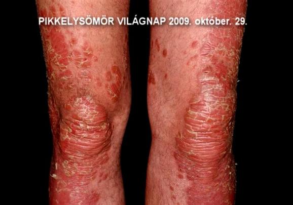 új a pikkelysömör kezelésében 2022- ban vörös foltok a testen és viszkető kezek